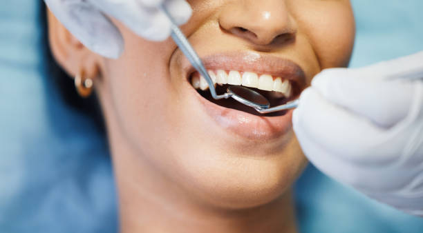 Best Knocked-Out Tooth (Avulsed Tooth) Treatment in Holladay, UT